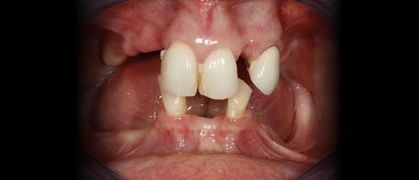 Antes - Reabilitação Total Superior e Inferior  com Dentes Fixos sobre Implantes