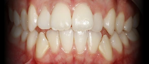 Antes - Correcção Dentária com Ortodontia Fixa