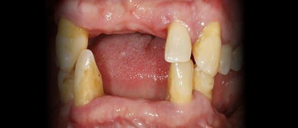 Antes - Reabilitação Oral com Implantes Dentários em ambos maxilares