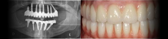 Depois - Reabilitação Oral com Implantes Dentários em ambos maxilares (visão radiográfica)