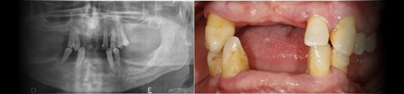Antes - Reabilitação Oral com Implantes Dentários em ambos maxilares (visão radiográfica)