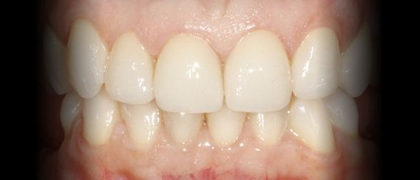 Depois - Correção da estética dentária com Facetas em Cerâmica - sistema cerec Cad-cam