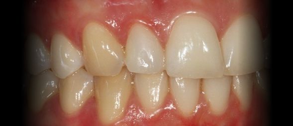 Depois - Correcção de Dente com Resina Composta