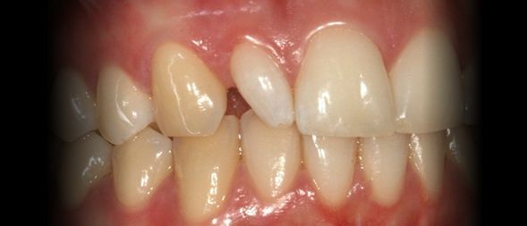 Antes - Correcção de Dente com Resina Composta